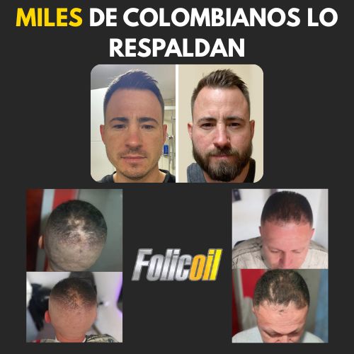 Tonico capilar FOLICOIL recupera tu cabello sin quimicos